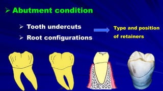  Tooth undercuts
 Root configurations
Type and position
of retainers
 Abutment condition
 