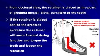  From occlusal view, the retainer is placed at the point
of greatest mesial- distal curvature of the tooth
Point of greatest
Position of the retainer
mesial distal curvature
 If the retainer is placed
behind the greatest
curvature the retainer
will move forward during
function and torque the
tooth and loosen the
retention
 