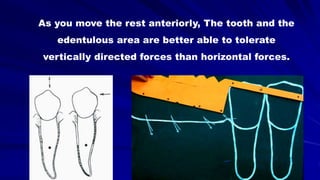 As you move the rest anteriorly, The tooth and the
edentulous area are better able to tolerate
vertically directed forces than horizontal forces.
 