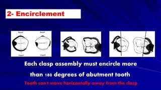 2- Encirclement
Each clasp assembly must encircle more
than 180 degrees of abutment tooth
Tooth can't move horizontally away from the clasp
 