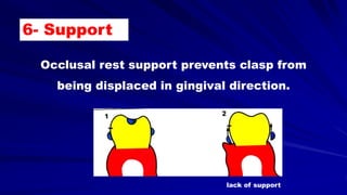 6- Support
Occlusal rest support prevents clasp from
being displaced in gingival direction.
lack of support
 