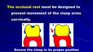 Secure the clasp in its proper position
The occlusal rest must be designed to
prevent movement of the clasp arms
cervically.
 
