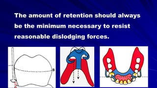 The amount of retention should always
be the minimum necessary to resist
reasonable dislodging forces.
 