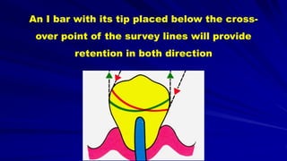 An I bar with its tip placed below the cross-
over point of the survey lines will provide
retention in both direction
 