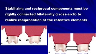 Stabilizing and reciprocal components must be
rigidly connected bilaterally (cross-arch) to
realize reciprocation of the retentive elements
 