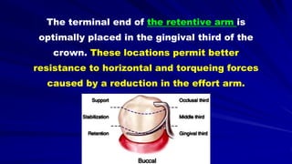 The terminal end of the retentive arm is
optimally placed in the gingival third of the
crown. These locations permit better
resistance to horizontal and torqueing forces
caused by a reduction in the effort arm.
 