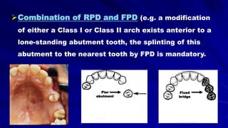 Combination of RPD and FPD (e.g. a modification
of either a Class I or Class II arch exists anterior to a
lone-standing abutment tooth, the splinting of this
abutment to the nearest tooth by FPD is mandatory.
Pier
abutment
Fixed
bridge
 