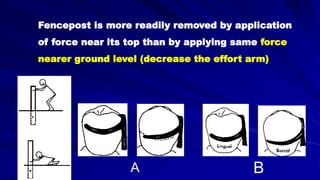 Fencepost is more readily removed by application
of force near its top than by applying same force
nearer ground level (decrease the effort arm)
A B
 