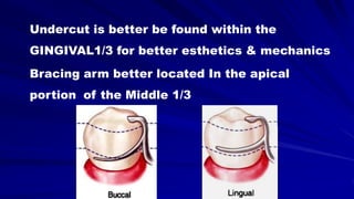 Undercut is better be found within the
GINGIVAL1/3 for better esthetics & mechanics
Bracing arm better located In the apical
portion of the Middle 1/3
 