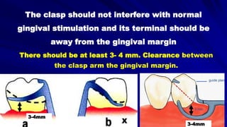 The clasp should not interfere with normal
gingival stimulation and its terminal should be
away from the gingival margin
X
3-4mm
3-4mm
There should be at least 3- 4 mm. Clearance between
the clasp arm the gingival margin.
 