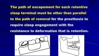 The path of escapement for each retentive
clasp terminal must be other than parallel
to the path of removal for the prosthesis to
require clasp engagement with the
resistance to deformation that is retention.
 