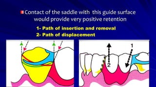 Contact of the saddle with this guide surface
would provide very positive retention
1- Path of insertion and removal
2- Path of displacement
 