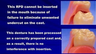 This RPD cannot be inserted
in the mouth because of
failure to eliminate unwanted
undercut on the cast.
This denture has been processed
on a correctly prepared cast and,
as a result, there is no
interference with insertion.
 