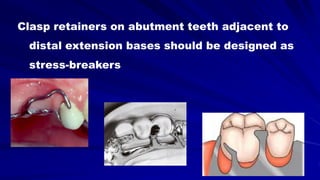 Clasp retainers on abutment teeth adjacent to
distal extension bases should be designed as
stress-breakers
 