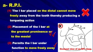 (1) The I bar placed on the distal cannot move
freely away from the tooth thereby producing a
torqueing action
Occlusal view of an RPI clasp.
a- R.P.I.
(2) Placement of the I bar at
the greatest prominence or
to the mesial
(3) Permits the I bar under
function to move freely away
 