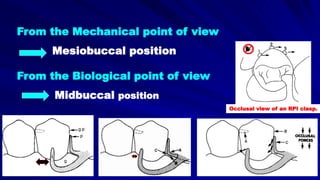 Occlusal view of an RPI clasp.
From the Mechanical point of view
Mesiobuccal position
From the Biological point of view
Midbuccal position
 