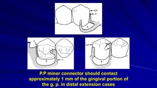 P.P minor connector should contact
approximately 1 mm of the gingival portion of
the g. p. in distal extension cases
 