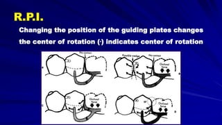Changing the position of the guiding plates changes
the center of rotation (.) indicates center of rotation
R.P.I.
 