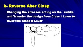b- Reverse Aker Clasp
F
Changing the stresses acting on the saddle
and Transfer the design from Class I Lever to
favorable Class II Lever
 