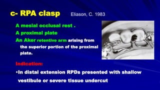 A mesial occlusal rest .
A proximal plate
An Aker retentive arm arising from
the superior portion of the proximal
plate.
Indication:
•In distal extension RPDs presented with shallow
vestibule or severe tissue undercut
c- RPA clasp Eliason, C. 1983
 