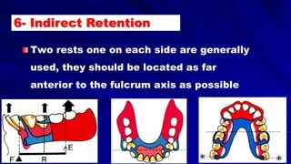 Two rests one on each side are generally
used, they should be located as far
anterior to the fulcrum axis as possible
6- Indirect Retention
 