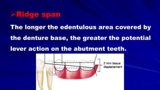 Ridge span
The longer the edentulous area covered by
the denture base, the greater the potential
lever action on the abutment teeth.
 
