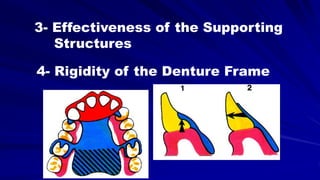 3- Effectiveness of the Supporting
Structures
4- Rigidity of the Denture Frame
 