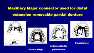 Maxillary Major connector used for distal
extension removable partial denture
Palatal strap
Anteroposterior
palatal bars
Palatal plate
 