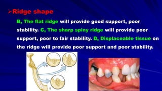 Ridge shape
B, The flat ridge will provide good support, poor
stability. C, The sharp spiny ridge will provide poor
support, poor to fair stability. D, Displaceable tissue on
the ridge will provide poor support and poor stability.
 