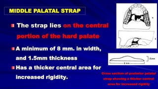 The strap lies on the central
portion of the hard palate
MIDDLE PALATAL STRAP
A minimum of 8 mm. in width,
and 1.5mm thickness
Has a thicker central area for
increased rigidity.
Cross section of posterior palatal
strap showing a thicker central
area for increased rigidity
 