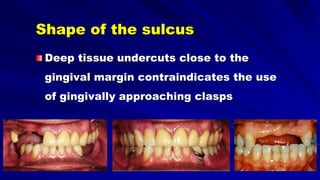 Shape of the sulcus
Deep tissue undercuts close to the
gingival margin contraindicates the use
of gingivally approaching clasps
 