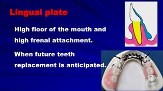 Lingual plate
High floor of the mouth and
high frenal attachment.
When future teeth
replacement is anticipated.
 