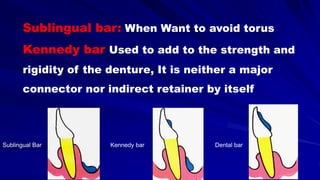 Sublingual Bar Dental barKennedy bar
Sublingual bar: When Want to avoid torus
Kennedy bar Used to add to the strength and
rigidity of the denture, It is neither a major
connector nor indirect retainer by itself
 