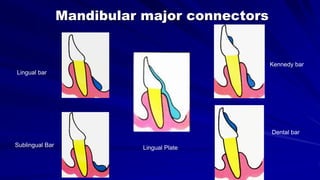 Mandibular major connectors
Lingual Plate
Lingual bar
Sublingual Bar
Dental bar
Kennedy bar
 