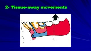 2- Tissue-away movements
 