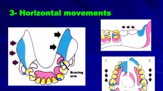3- Horizontal movements
Bracing
arm
 