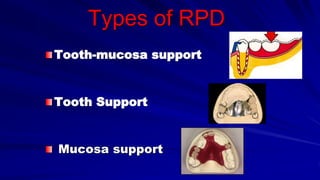 Types of RPD
Tooth-mucosa support
Tooth Support
Mucosa support
 
