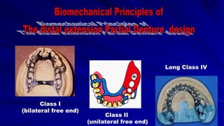 Class I
(bilateral free end)
Long Class IV
Class II
(unilateral free end)
 