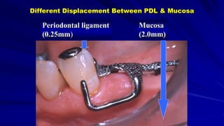 Periodontal ligament
(0.25mm)
Mucosa
(2.0mm)
Different Displacement Between PDL & Mucosa
 