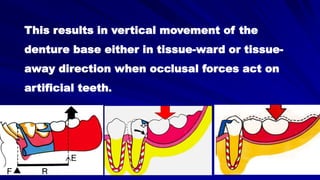 This results in vertical movement of the
denture base either in tissue-ward or tissue-
away direction when occlusal forces act on
artificial teeth.
 