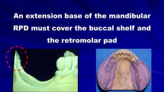 An extension base of the mandibular
RPD must cover the buccal shelf and
the retromolar pad
 