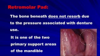 The bone beneath does not resorb due
to the pressure associated with denture
use.
It is one of the two
primary support areas
of the mandible
Retromolar Pad:
 