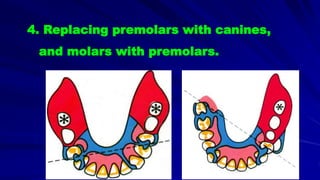 4. Replacing premolars with canines,
and molars with premolars.
 