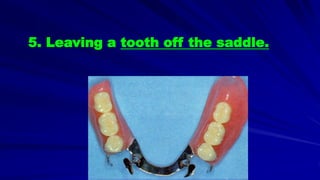 5. Leaving a tooth off the saddle.
 