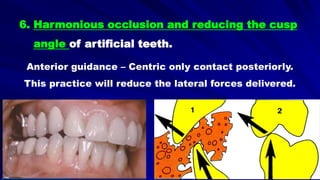 6. Harmonious occlusion and reducing the cusp
angle of artificial teeth.
Anterior guidance – Centric only contact posteriorly.
This practice will reduce the lateral forces delivered.
 