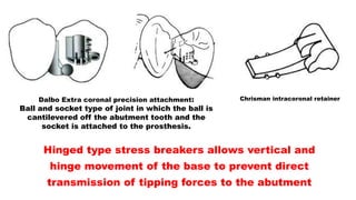 Dalbo Extra coronal precision attachment:
Ball and socket type of joint in which the ball is
cantilevered off the abutment tooth and the
socket is attached to the prosthesis.
Hinged type stress breakers allows vertical and
hinge movement of the base to prevent direct
transmission of tipping forces to the abutment
Chrisman intracoronal retainer
 