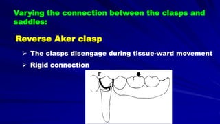 Varying the connection between the clasps and
saddles:
Reverse Aker clasp
 The clasps disengage during tissue-ward movement
 Rigid connection
F
 