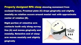 Properly designed RPA clasp showing movement from
occlusal forces. Proximal plate (C) drops gingivally and slightly
mesially as rotation occurs around mesial rest with approximate
center of rotation (B).
Rigid portion of retentive arm
contacts tooth only along survey
line (A) and moves gingivally and
mesially. Retentive end of clasp
arm moves mesially and slightly
gingivally
B
A C
 