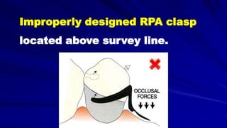 Improperly designed RPA clasp
located above survey line.
 