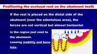 Positioning the occlusal rest on the abutment teeth
If the rest is placed on the distal side of the
abutment (near the edentulous area), the
forces are not vertical but almost horizontal
in the region just next to
the abutment.
causing mobility and bone
loss.
 
